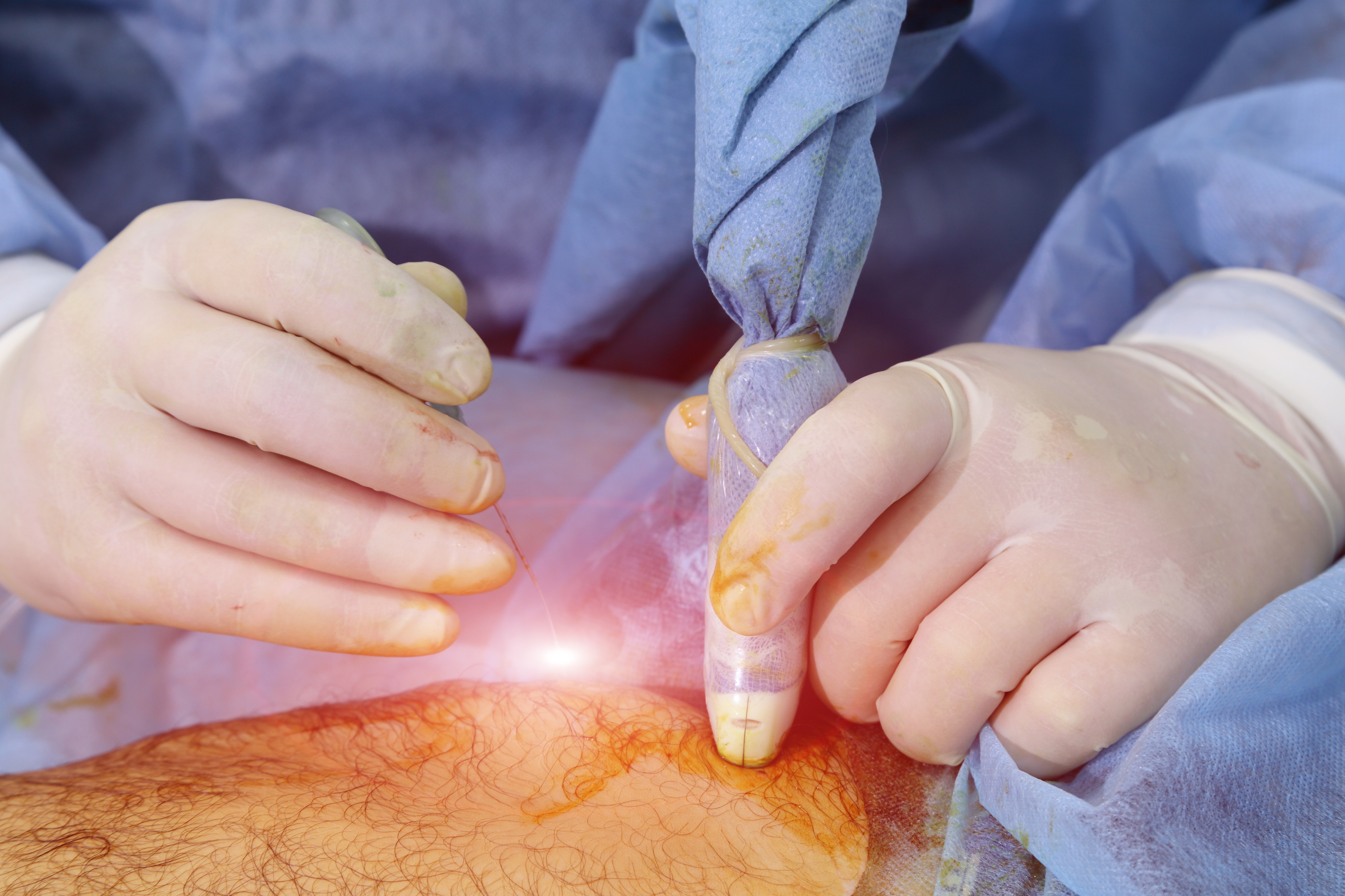 Miniaturka artykułu: Laser w leczeniu żylaków