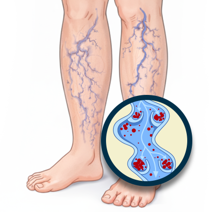 Nogi z żylakami - objawy