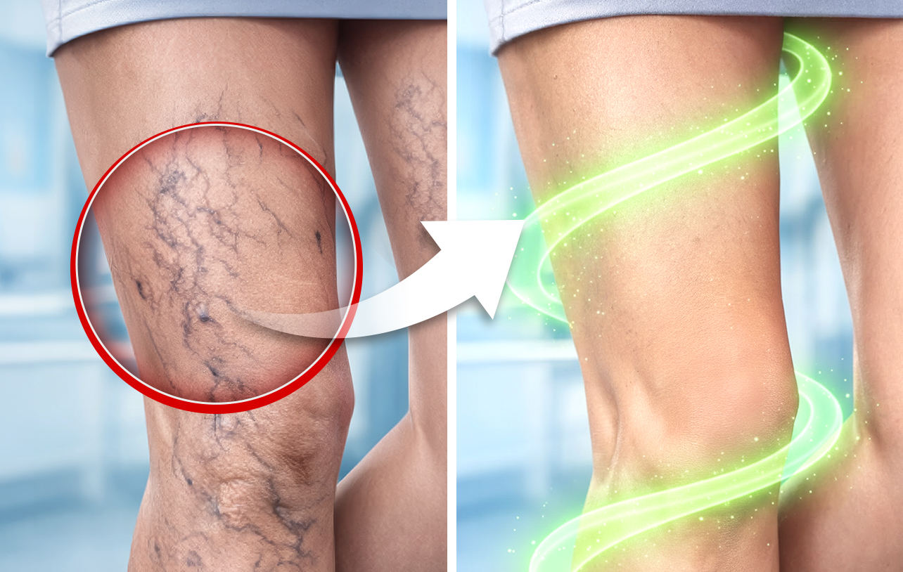 Preparat na żylaki - zdjęcie produktu